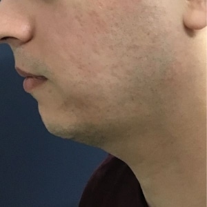 mans profile, after microneedling acne scarring is gone