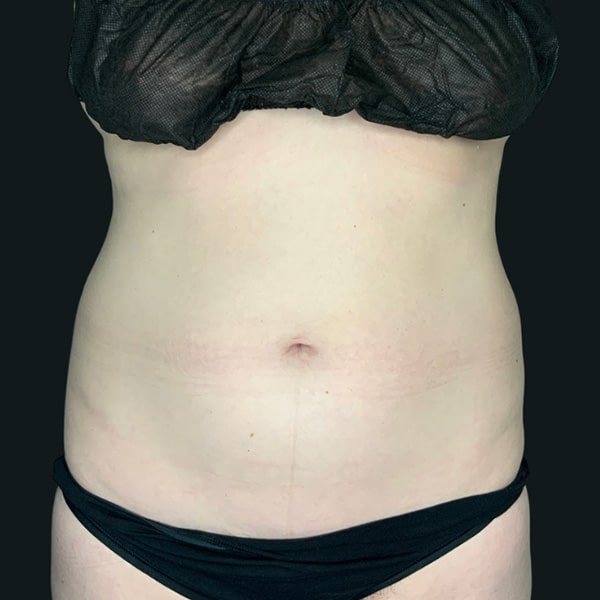 Coolsculpting Before And After