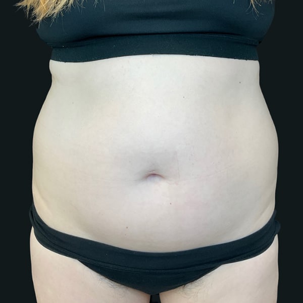 Reduce Back Fat with CoolSculpting