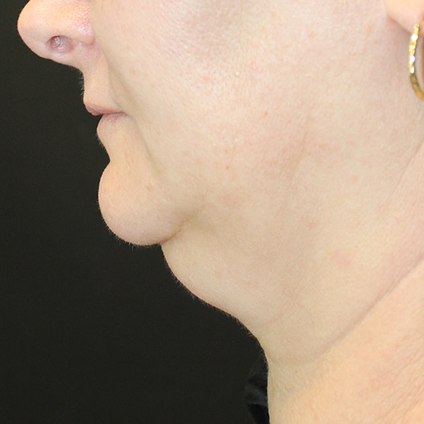 Double Chin Treatment in Bellingham, Burlington & Bothell | RejuvenationMD