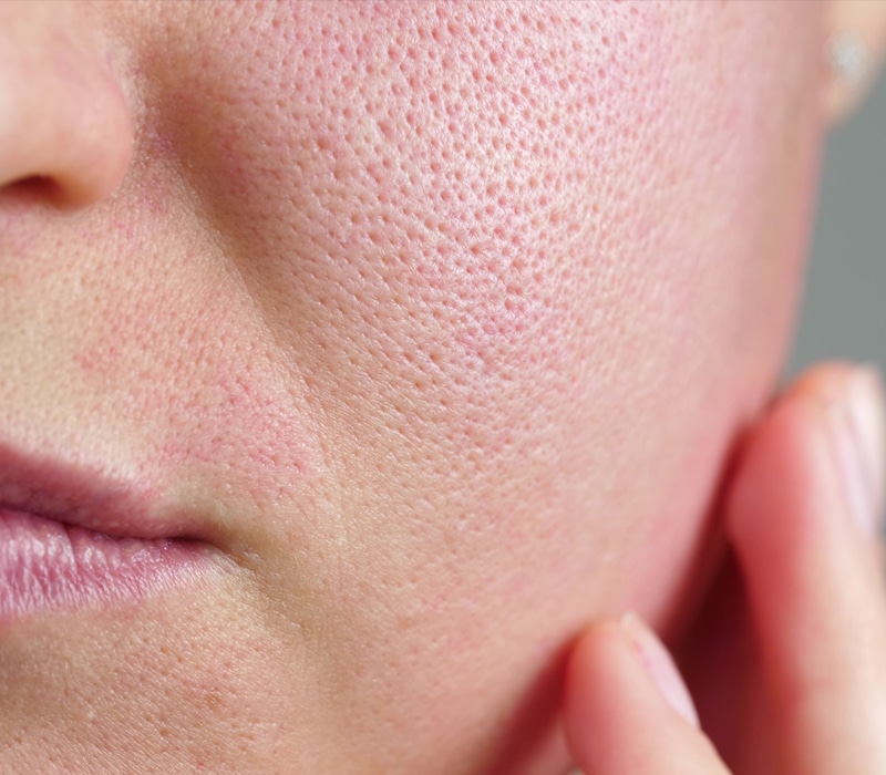 How To Treat Large Pores Rejuvenationmd Med Spas 